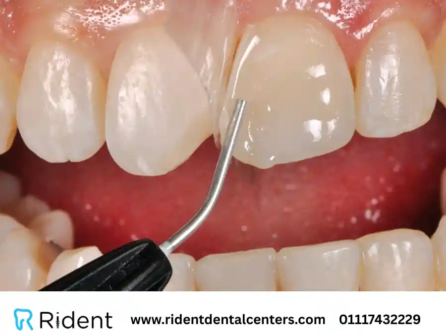 سعر حشوة الاسنان الامامية في السعودية